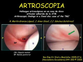 ARTROSCOPIA
          Hallazgos artroscópicos en un caso de disco
                 articular adherido de la ATM
    Arthroscopic findings in a fixed disc case of the TMJ

R. Martín-Granizo López1, J. Giner Díaz2, J.J. Sánchez Gutiérrez1




    CM: Cápsula medial
    BP: Banda posterior
                                  Rev Esp Cir Oral y Maxilofac 2005;27,6
                                 (Noviembre-Diciembre):344-350 © 2005
 