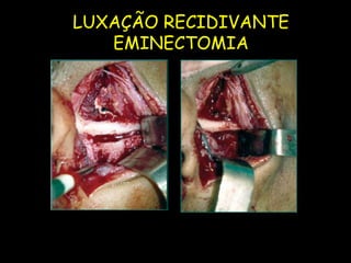 LUXAÇÃO RECIDIVANTE
              EMINECTOMIA
UFMS/NHU
 