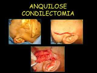 ANQUILOSE
UFMS/NHU   CONDILECTOMIA
 