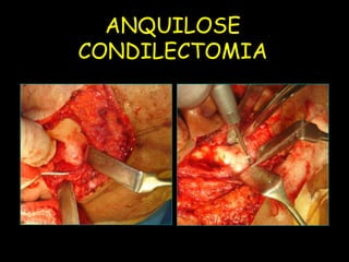 ANQUILOSE
           CONDILECTOMIA
UFMS/NHU
 