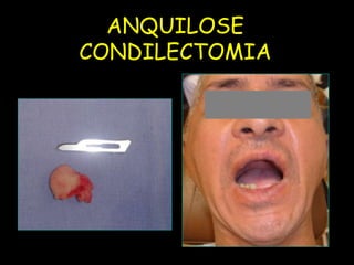 ANQUILOSE
           CONDILECTOMIA
UFMS/NHU
 