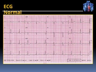 ECG
Normal
 
