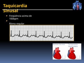 Taquicardia
Sinusal
Freqüência acima de
100bpm
Ritmo regular
 