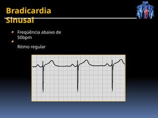 Bradicardia
Sinusal
Freqüência abaixo de
50bpm
Ritmo regular
 