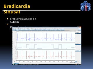 Bradicardia
Sinusal
Frequência abaixo de
50bpm
Ritmo irregular
 