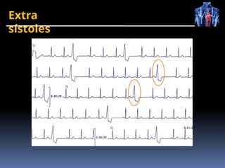 Extra
sístoles
 