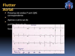 Flutter
Atrial
Presença de ondas P sem QRS
correspondente
Apenas o atrio sai do
padrão Entrada de
focos ectópicos
 