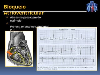 Bloqueio
Atrioventricular
x
Atraso na passagem do
estímulo
Prolongamento no segmento
P-R
 