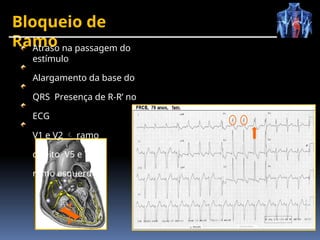 Bloqueio de
Ramo
x
Atraso na passagem do
estímulo
Alargamento da base do
QRS Presença de R-R’ no
ECG
V1 e V2  ramo
direito V5 e V6 
ramo esquerdo
 