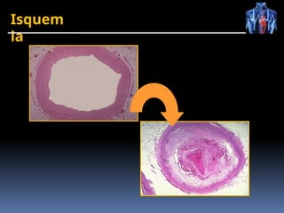 Isquem
ia
 