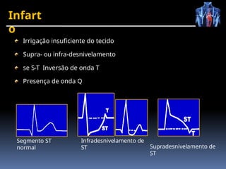 Infart
o
Irrigação insuficiente do tecido
Supra- ou infra-desnivelamento
se S-T Inversão de onda T
Presença de onda Q
Segmento ST
normal
Infradesnivelamento de
ST Supradesnivelamento de
ST
 