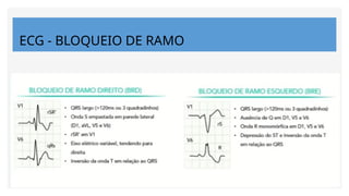 ECG - BLOQUEIO DE RAMO
 