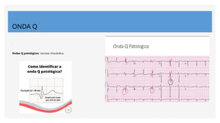 ONDA Q
.
Ondas Q patológicas: necrose miocárdica.
 