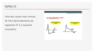 INFRA ST
Uma das causas mais comuns
de infra-desnivelamento de
segmento ST é a isquemia
miocárdica.
 
