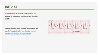 INFRA ST
O infradesnível do ST pode ser transitório (na
angina) ou persistente (no Infarto sem elevação
do ST).
Tambén aparece como imagem recíproca ou "em
espelho" nas derivações não afetadas por um
infarto com elevação do segmento ST.
 