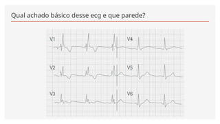 Qual achado básico desse ecg e que parede?
 
