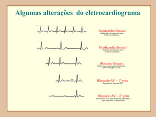 Algumas alterações do eletrocardiograma
Taquicardia Sinusal
Diminuição do intervalo entre
os ciclos cardíacos.
Bradicardia Sinusal
Aumento do intervalo entre
os ciclos cardíacos.
Bloqueio Sinusal
Marca passo para temporariamente,
pelo menos por 1 ciclo
Bloqueio AV – 1º grau
Aumento do intervalo PR
PR
Bloqueio AV – 2º grau
Necessários 2 ou mais impulsos auriculares
para estimular o vemntrículo
 