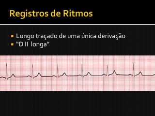    Longo traçado de uma única derivação
   “D II longa”
 