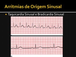    Taquicardia Sinusal e Bradicardia Sinusal
 