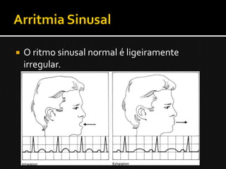    O ritmo sinusal normal é ligeiramente
    irregular.
 