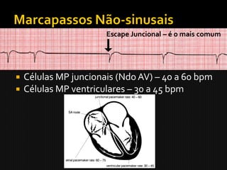 Escape Juncional – é o mais comum

   Células MP sinusais – 60 a 100 bpm
   Células MP atriais – 60 a 75 bpm
   Células MP juncionais (Ndo AV) – 40 a 60 bpm
   Células MP ventriculares – 30 a 45 bpm
 