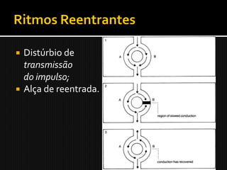  Distúrbio de
  transmissão
  do impulso;
 Alça de reentrada.
 