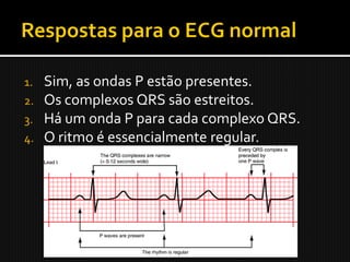 1.   Sim, as ondas P estão presentes.
2.   Os complexos QRS são estreitos.
3.   Há um onda P para cada complexo QRS.
4.   O ritmo é essencialmente regular.
 
