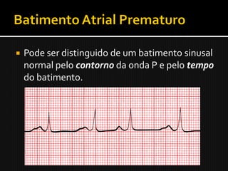    Pode ser distinguido de um batimento sinusal
    normal pelo contorno da onda P e pelo tempo
    do batimento.
 
