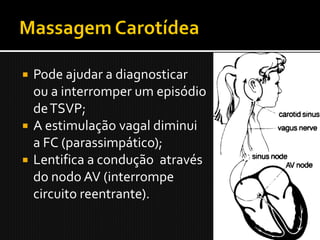  Pode ajudar a diagnosticar
  ou a interromper um episódio
  de TSVP;
 A estimulação vagal diminui
  a FC (parassimpático);
 Lentifica a condução através
  do nodo AV (interrompe
  circuito reentrante).
 