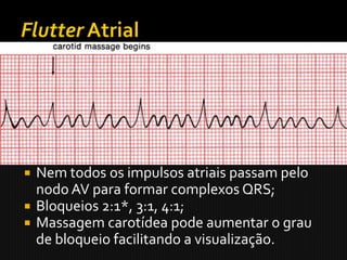    Ritmo regular;
   Ondas P aparecem com um freqüência de 250
    a 350 bpm;
   Ondas de flutter, configuração em dente-de-
    serra;
   Nem todos os impulsos atriais passam pelo
    nodo AV para formar complexos QRS;
   Bloqueios 2:1*, 3:1, 4:1;
   Massagem carotídea pode aumentar o grau
    de bloqueio facilitando a visualização.
 