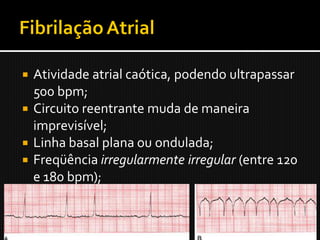  Atividade atrial caótica, podendo ultrapassar
  500 bpm;
 Circuito reentrante muda de maneira
  imprevisível;
 Linha basal plana ou ondulada;
 Freqüência irregularmente irregular (entre 120
  e 180 bpm);
 