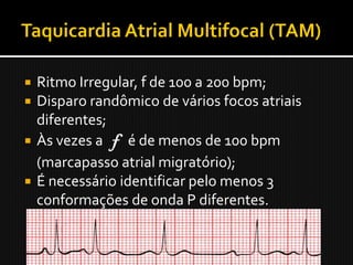  Ritmo Irregular, f de 100 a 200 bpm;
 Disparo randômico de vários focos atriais
  diferentes;
 Às vezes a f é de menos de 100 bpm
  (marcapasso atrial migratório);
 É necessário identificar pelo menos 3
  conformações de onda P diferentes.
 