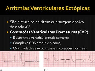  São distúrbios de ritmo que surgem abaixo
  do nodo AV.
 Contrações Ventriculares Prematuras (CVP)
     É a arritmia ventricular mais comum;
     Complexo QRS amplo e bizarro;
     CVPs isoladas são comuns em corações normais;
     Atenção à CVP isolada no contexto de um IAM.
     Bigeminismo 1 sinusal : 1 cpv, Trigeminismo 2
     sinuais : 1 cpv.
 