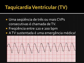  Uma seqüência de três ou mais CVPs
  consecutivas é chamada de TV.
 Freqüência entre 120 e 200 bpm
 A TV sustentada é uma emergência médica!
 