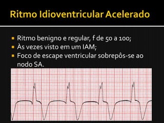  Ritmo benigno e regular, f de 50 a 100;
 Às vezes visto em um IAM;
 Foco de escape ventricular sobrepôs-se ao
  nodo SA.
 Raramente é continuado;
 Não progride para fibrilação ventricular;
 Raramente requer tratamento.
 