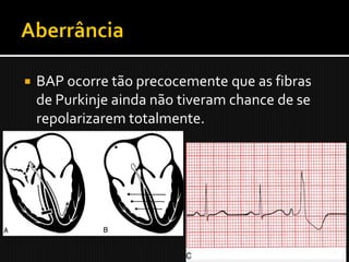    BAP ocorre tão precocemente que as fibras
    de Purkinje ainda não tiveram chance de se
    repolarizarem totalmente.
 
