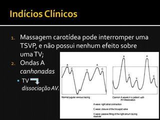1. Massagem carotídea pode interromper uma
   TSVP, e não possui nenhum efeito sobre
   uma TV;
2. Ondas A
   canhonadas
      TV
      dissociação AV.
 