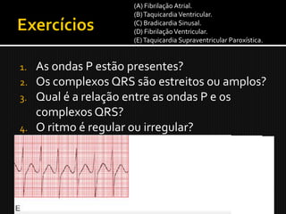 (A) Fibrilação Atrial.
                    (B) Taquicardia Ventricular.
                    (C) Bradicardia Sinusal.
                    (D) Fibrilação Ventricular.
                    (E) Taquicardia Supraventricular Paroxística.


1. As ondas P estão presentes?
2. Os complexos QRS são estreitos ou amplos?
3. Qual é a relação entre as ondas P e os
   complexos QRS?
4. O ritmo é regular ou irregular?
 