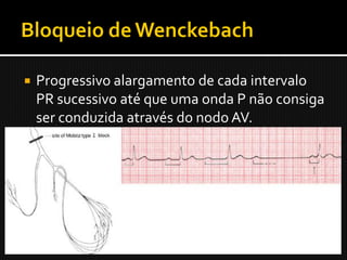    Progressivo alargamento de cada intervalo
    PR sucessivo até que uma onda P não consiga
    ser conduzida através do nodo AV.
 