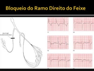  O complexo QRS alarga-se além dos 0,12 s;
 Inscrição de uma segunda onda R (R’) nas
  derivações V1 e V2
 Complexo RSR’ (orelhas de coelho);
 Ondas S profundas e tardias em ventrículo
  esquerdo (I, aVL, V5 e V6).
 