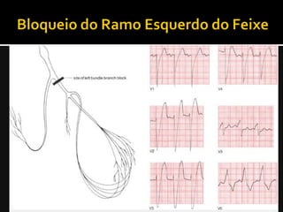    Despolarização ventricular esquerda se
    encontra atrasada;
   QRS largo (t>0,12s);
   Ondas R largas no ápice ou entalhadas nas
    derivações sob o VE;
   Ondas S recíprocas nas D sob o VD;
   Pode haver desvio de eixo para a esquerda.
 