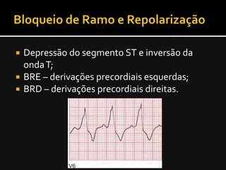  Depressão do segmento ST e inversão da
  onda T;
 BRE – derivações precordiais esquerdas;
 BRD – derivações precordiais direitas.
 