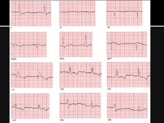 1.   Há algum bloqueio AV?
2.   Há algum bloqueio de ramo de feixe?
3.   Há algum hemibloqueio?
 