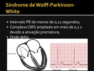  Intervalo PR de menos de 0,12 segundos;
 Complexo QRS ampliado em mais de 0,1 s
  devido a ativação prematura;
 Onda delta.
 
