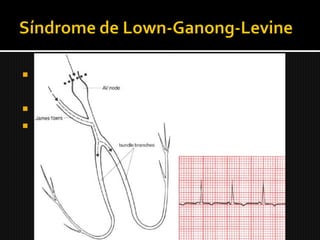  O intervalo PR está encurtado, durando
  menos de 0,12 segundos;
 O complexo QRS não está alargado;
 Não há onda delta.
 