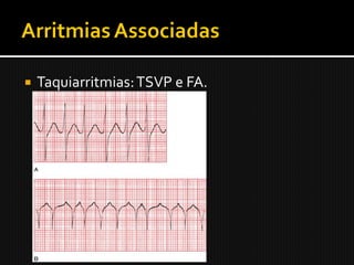    Taquiarritmias: TSVP e FA.
 