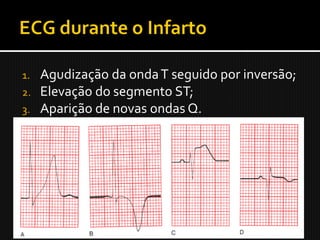 1.   Agudização da onda T seguido por inversão;
2.   Elevação do segmento ST;
3.   Aparição de novas ondas Q.
 
