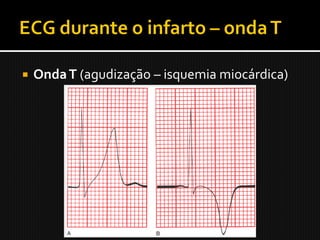    Onda T (agudização – isquemia miocárdica)
 