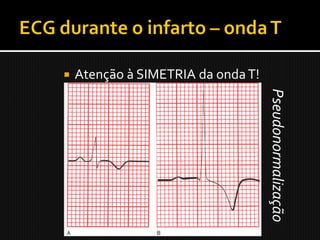    Atenção à SIMETRIA da onda T!




                                    Pseudonormalização
 
