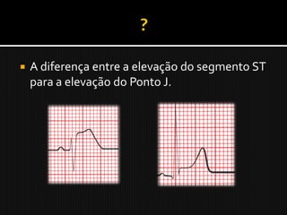    A diferença entre a elevação do segmento ST
    para a elevação do Ponto J.
 